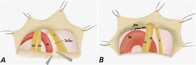 Comparison of Microvascular Decompression and Two Isocenters Gamma Knife for the Treatment of Trigeminal Neuralgia Caused by Vertebrobasilar Dolichoectasia